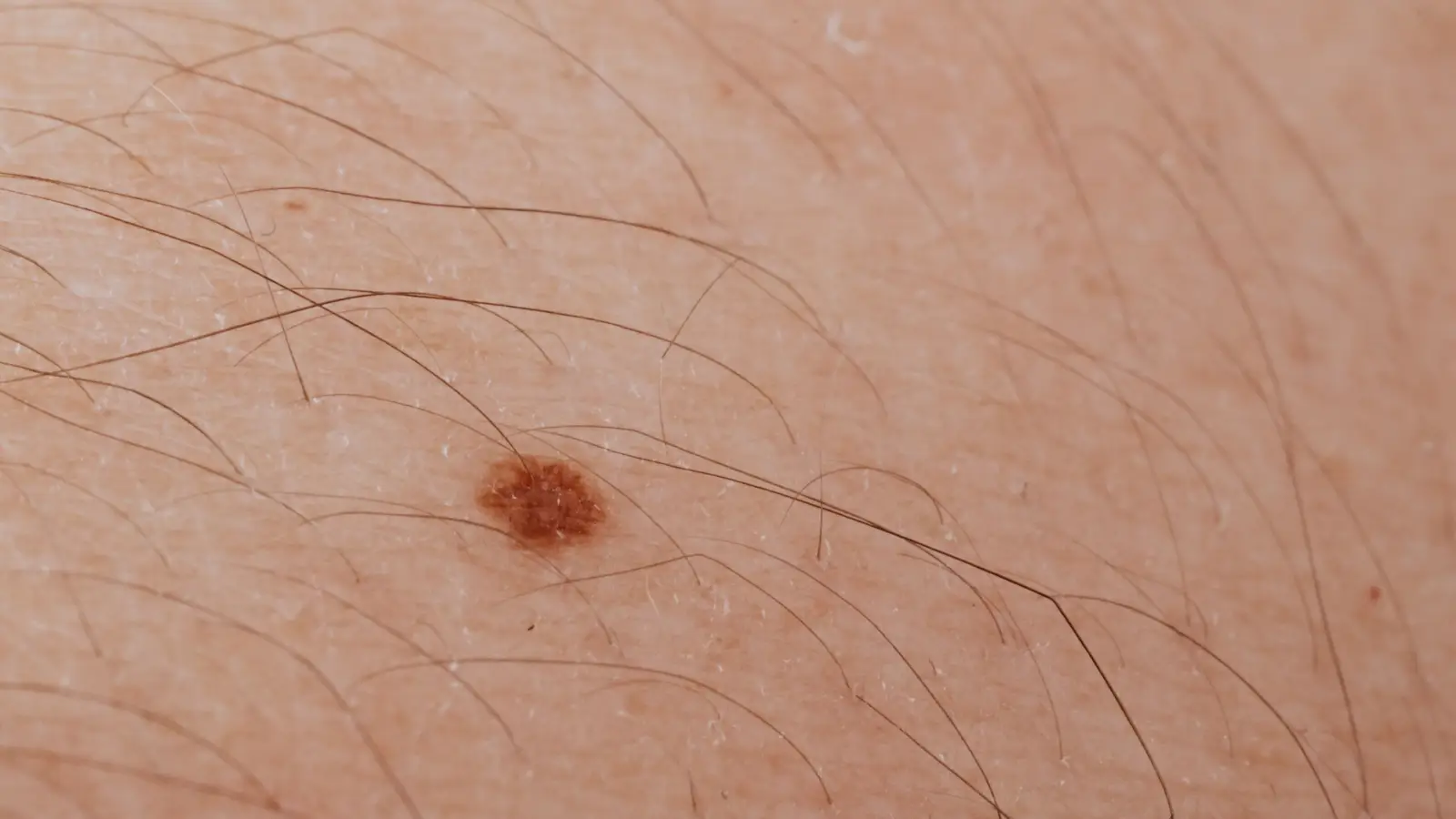 The 1064 nm Wavelength Detail That Changes Spot Treatment
