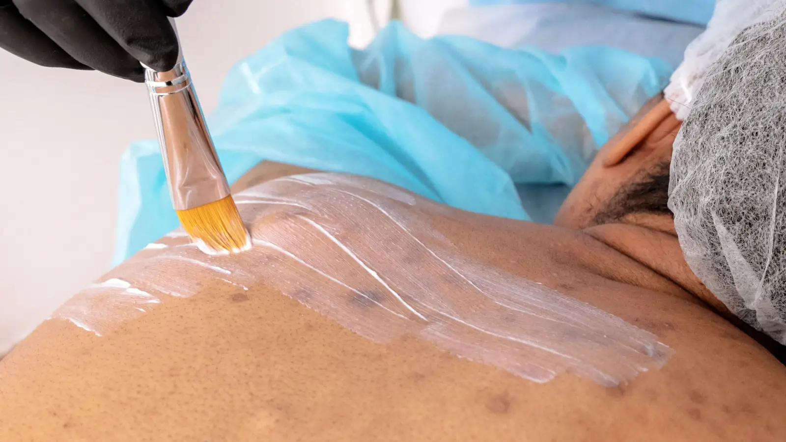 Chemical Peel for Dark Spots: Avoid This Depth Mistake