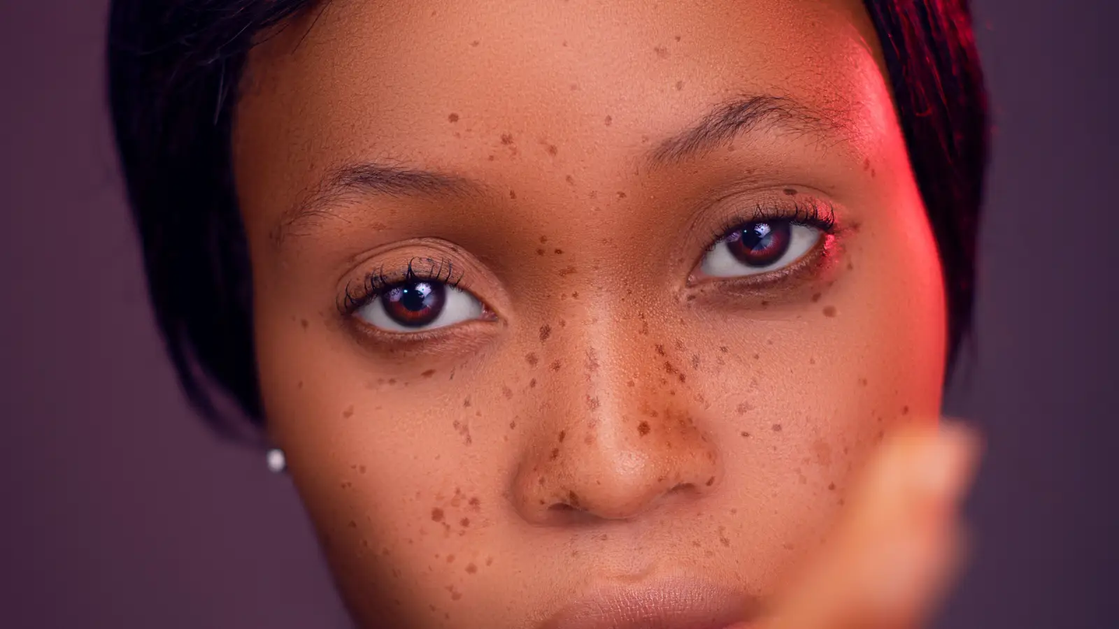 Dark Skin? Why Pico Laser Might Be Your Safest Option