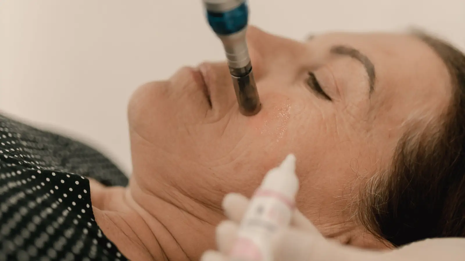 Dark spots won’t budge? Microneedling may be your answer