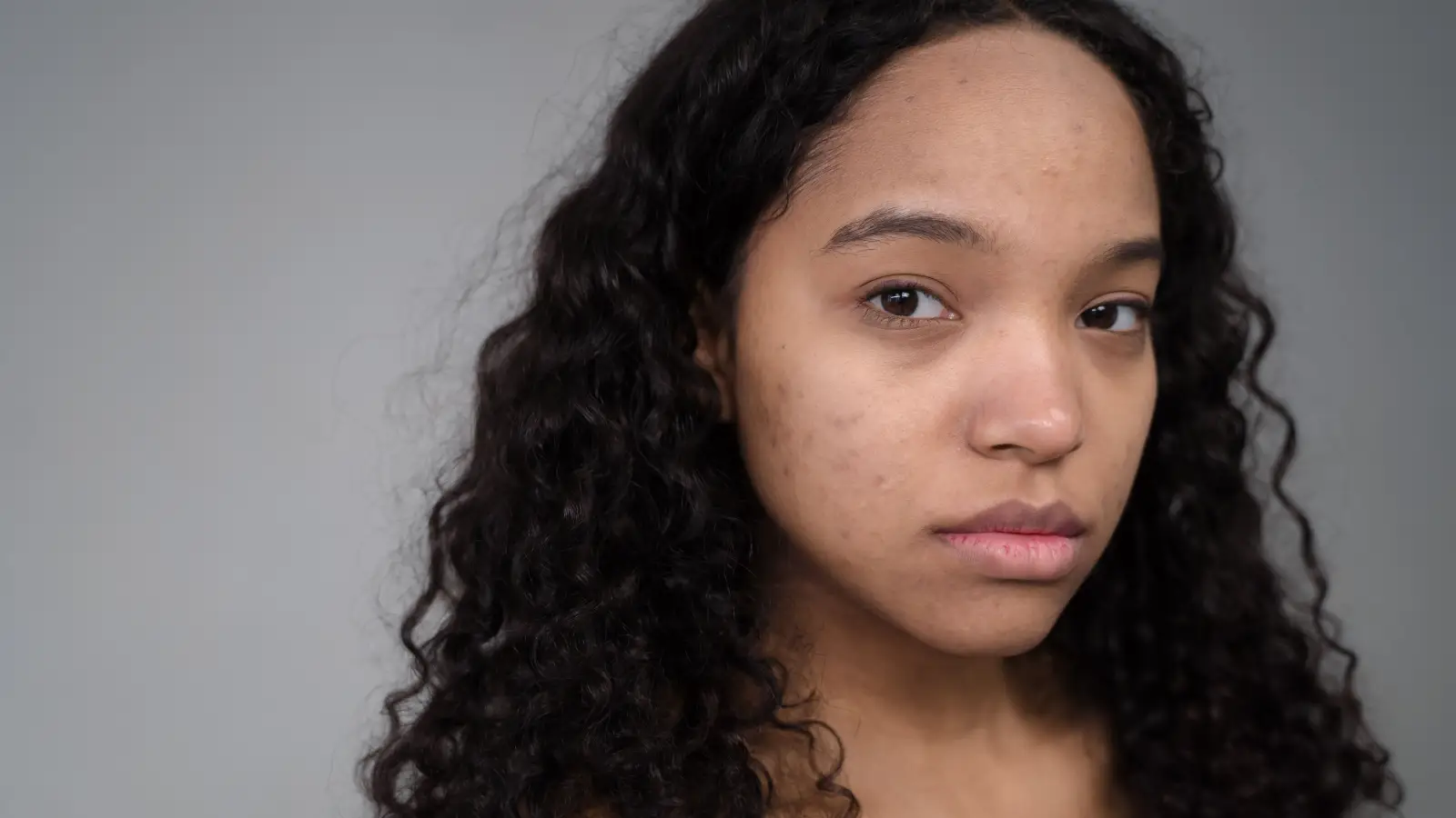 Fade Post-Inflammatory Hyperpigmentation When Nothing Works