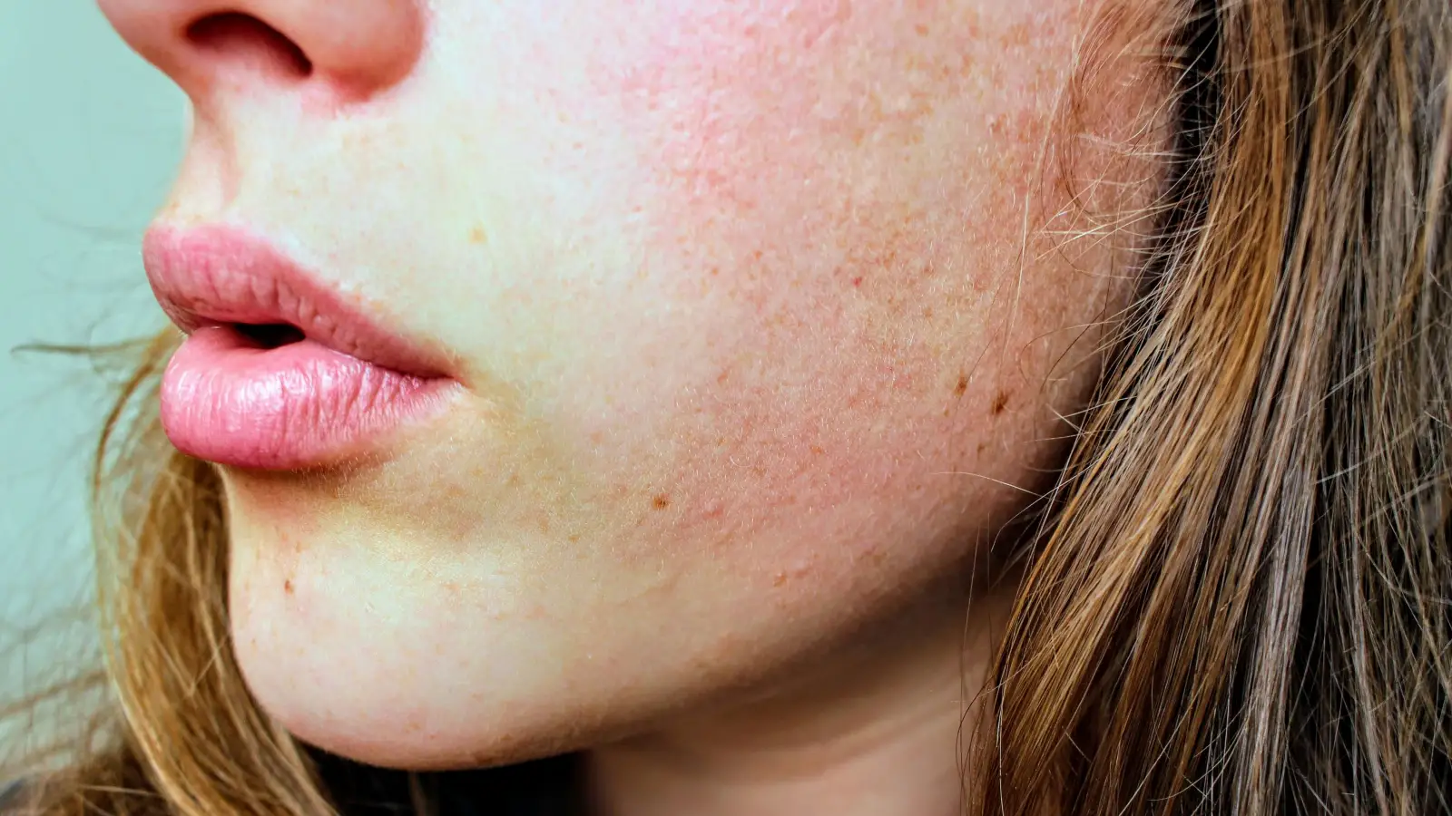 The Fitzpatrick Scale: What Dermatologists Check Before Treating Spots