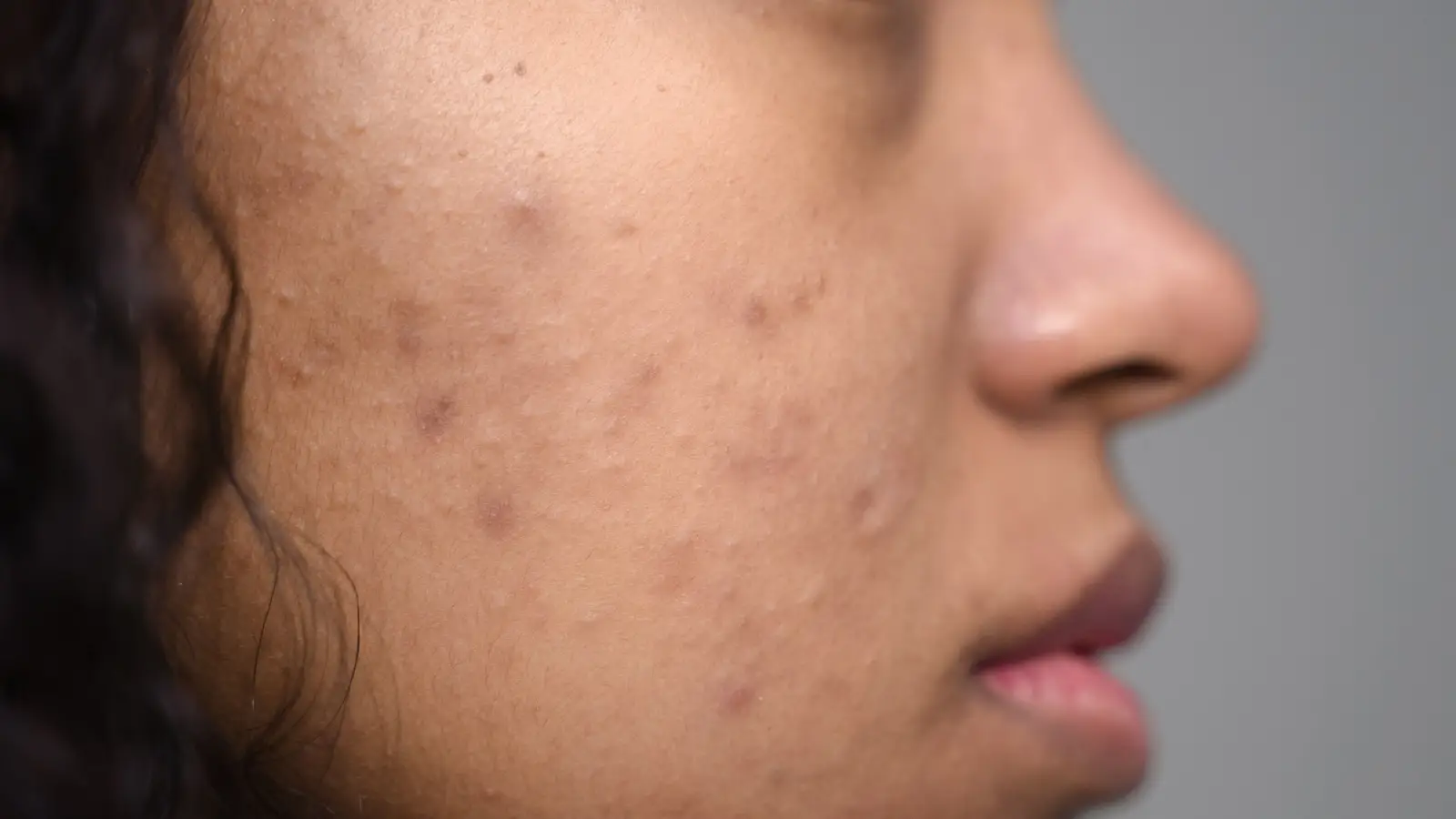 Fraxel for Acne Scars: Hope for Smoother Skin