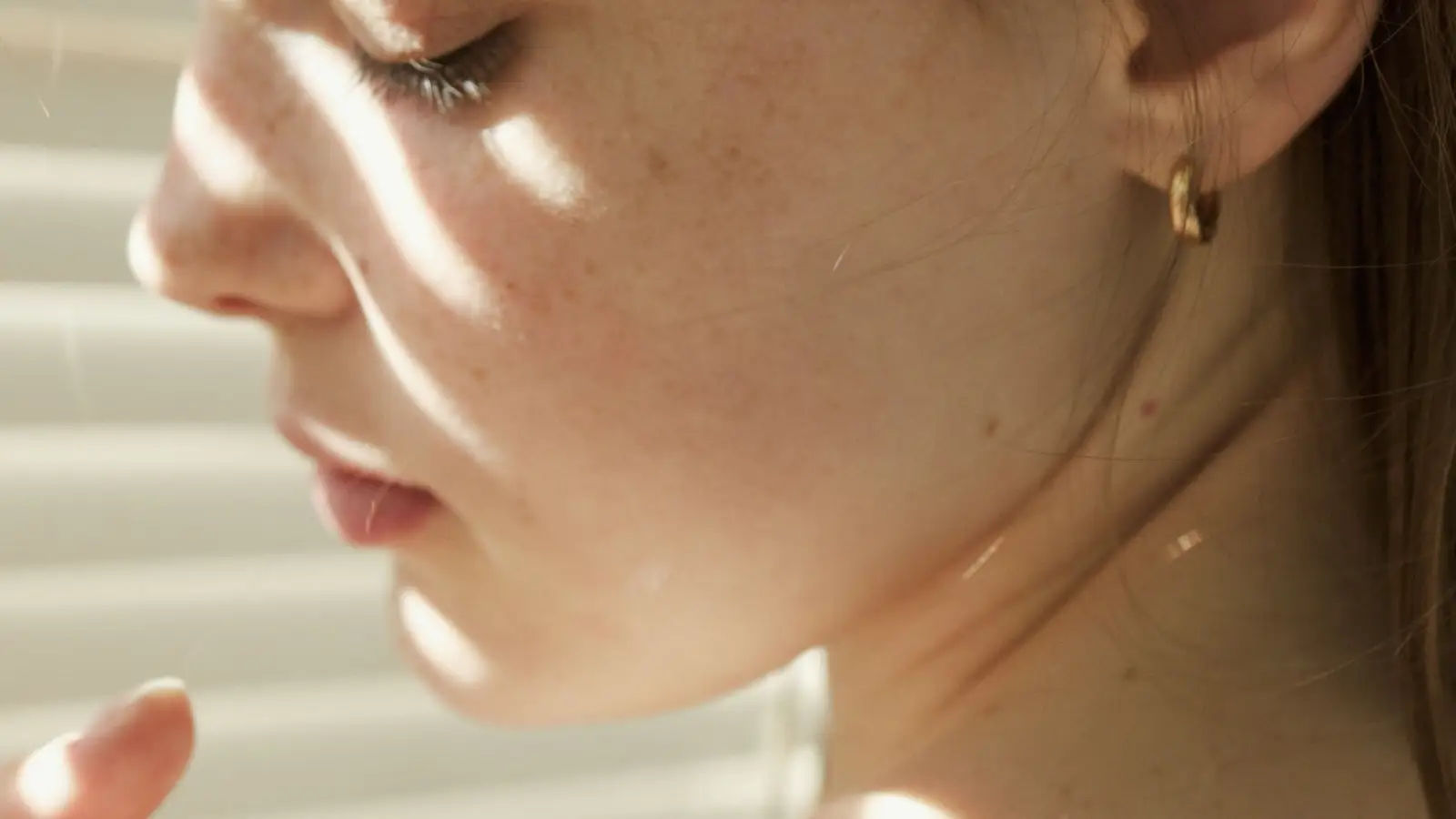 IPL Works on Sun Spots, Not Melasma—The Skin Type Key