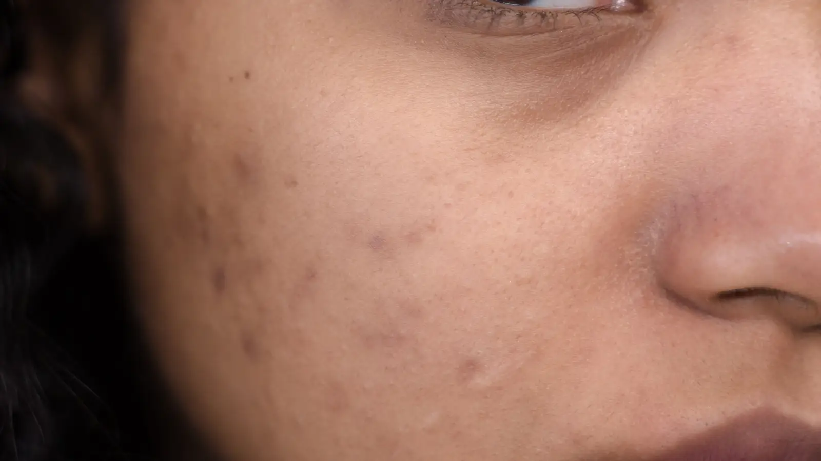 Natural Dark Spot Remedies: Why Dermatologists Say No