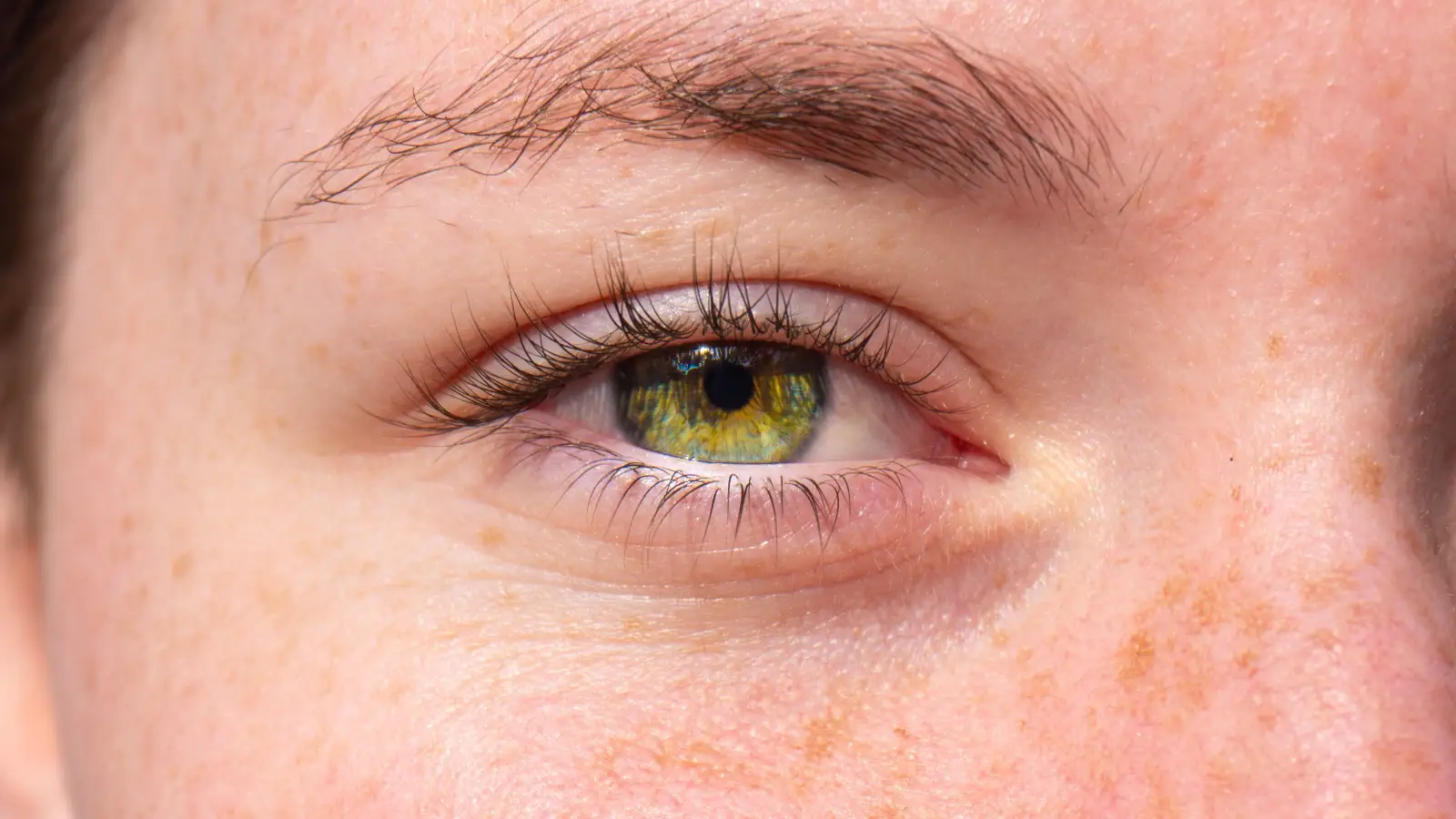 PIH Can Look Like Sun Spots—One Clue to Tell Them Apart