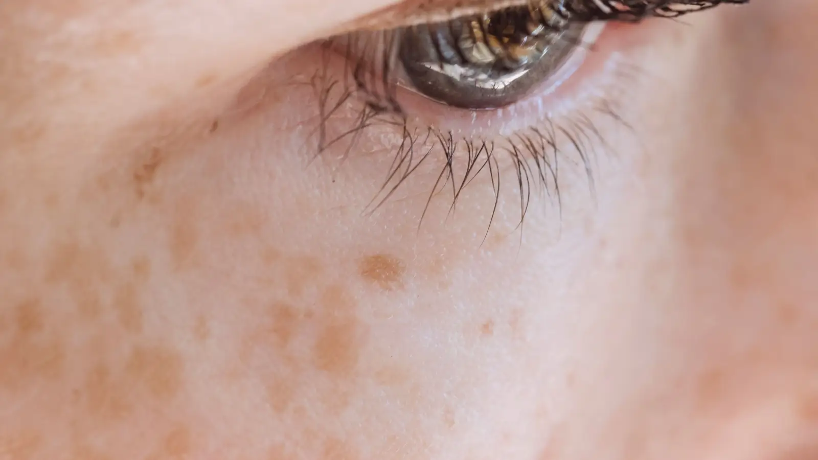 Retinoid or Hydroquinone for Dark Spots: Which Works Faster?