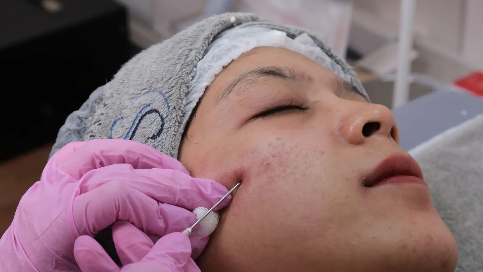 7-day healing after microneedling for dark spots