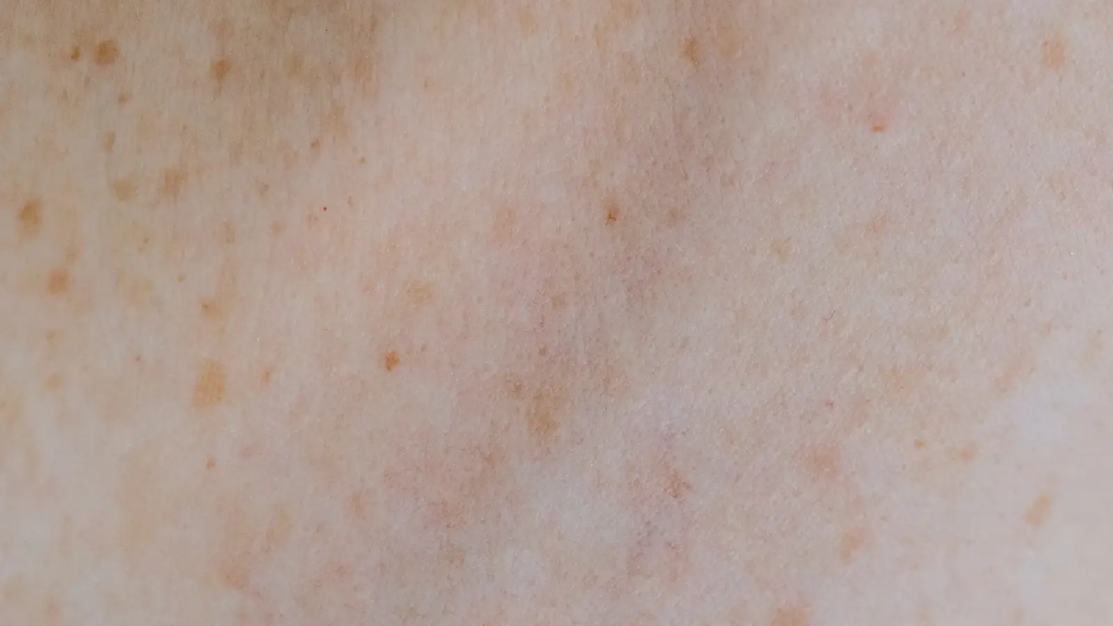 7 Days After Nd:YAG Laser: A Realistic Healing Timeline
