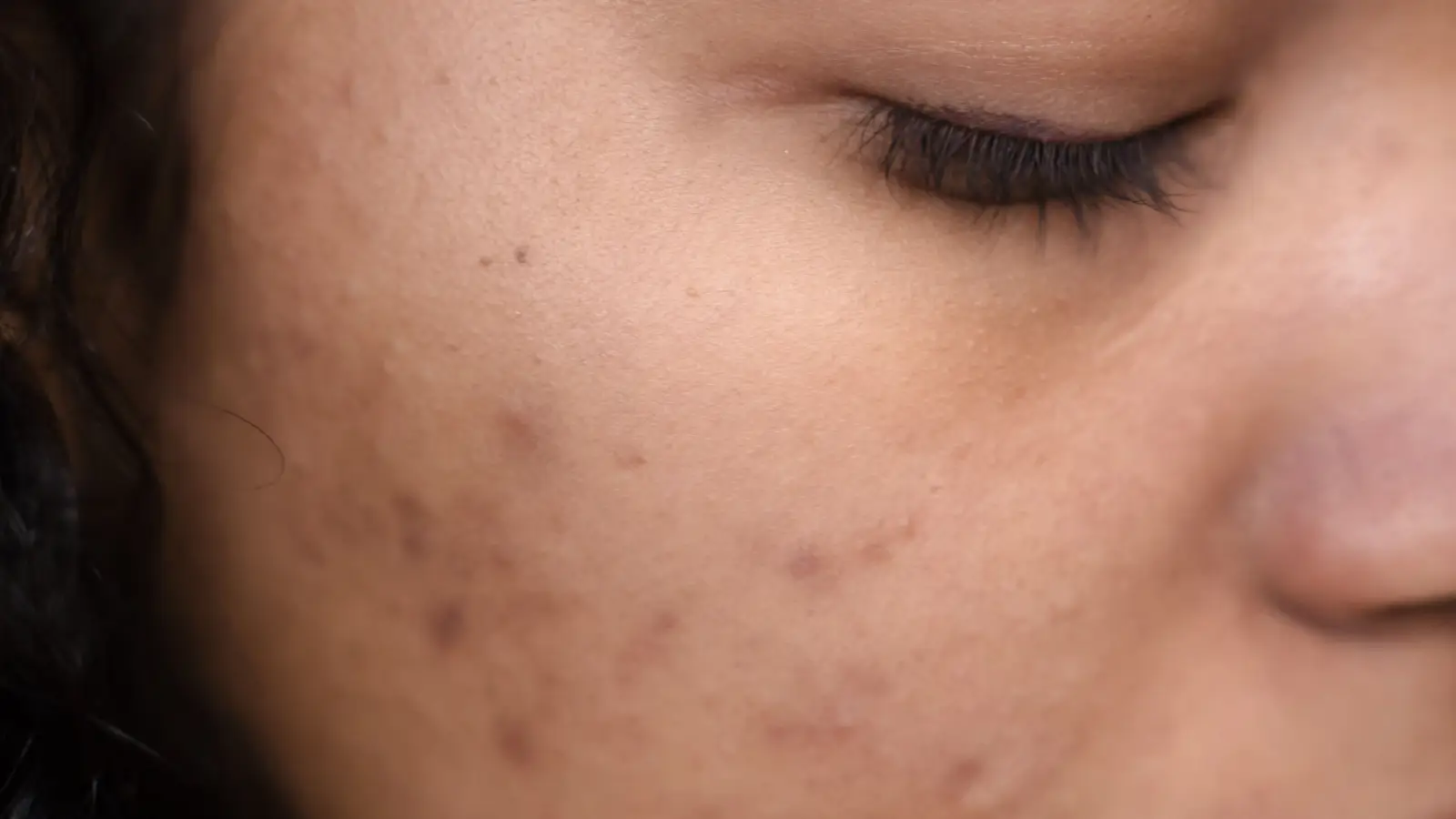 The 72-Hour Window to Prevent a Dark Spot After a Blemish