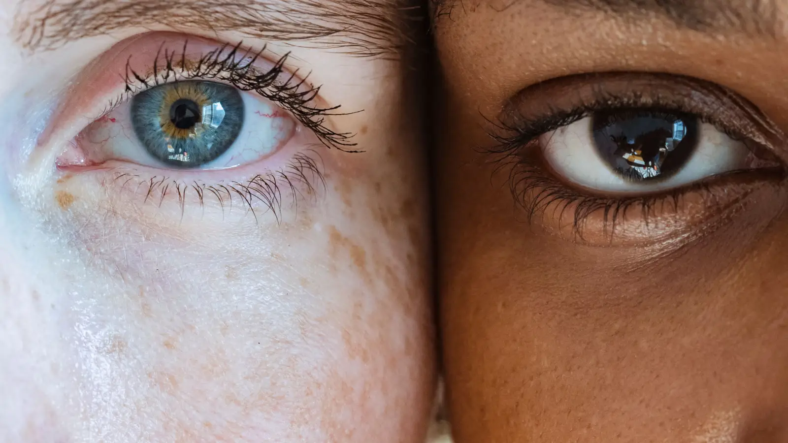 Think Melasma Only Affects Dark Skin? The Fitzpatrick Misconception
