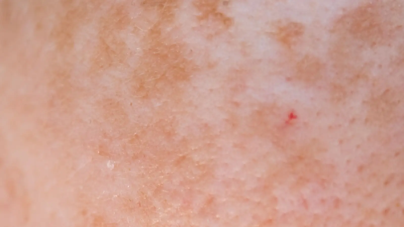 3 Peel Depths, 6 Fitzpatrick Types: A Safety Guide
