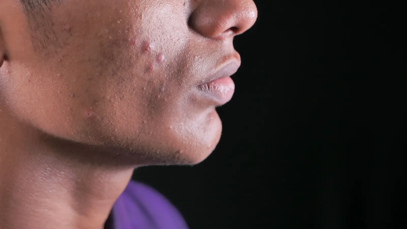 What Dermatologists Do Differently When Microneedling for Dark Spots