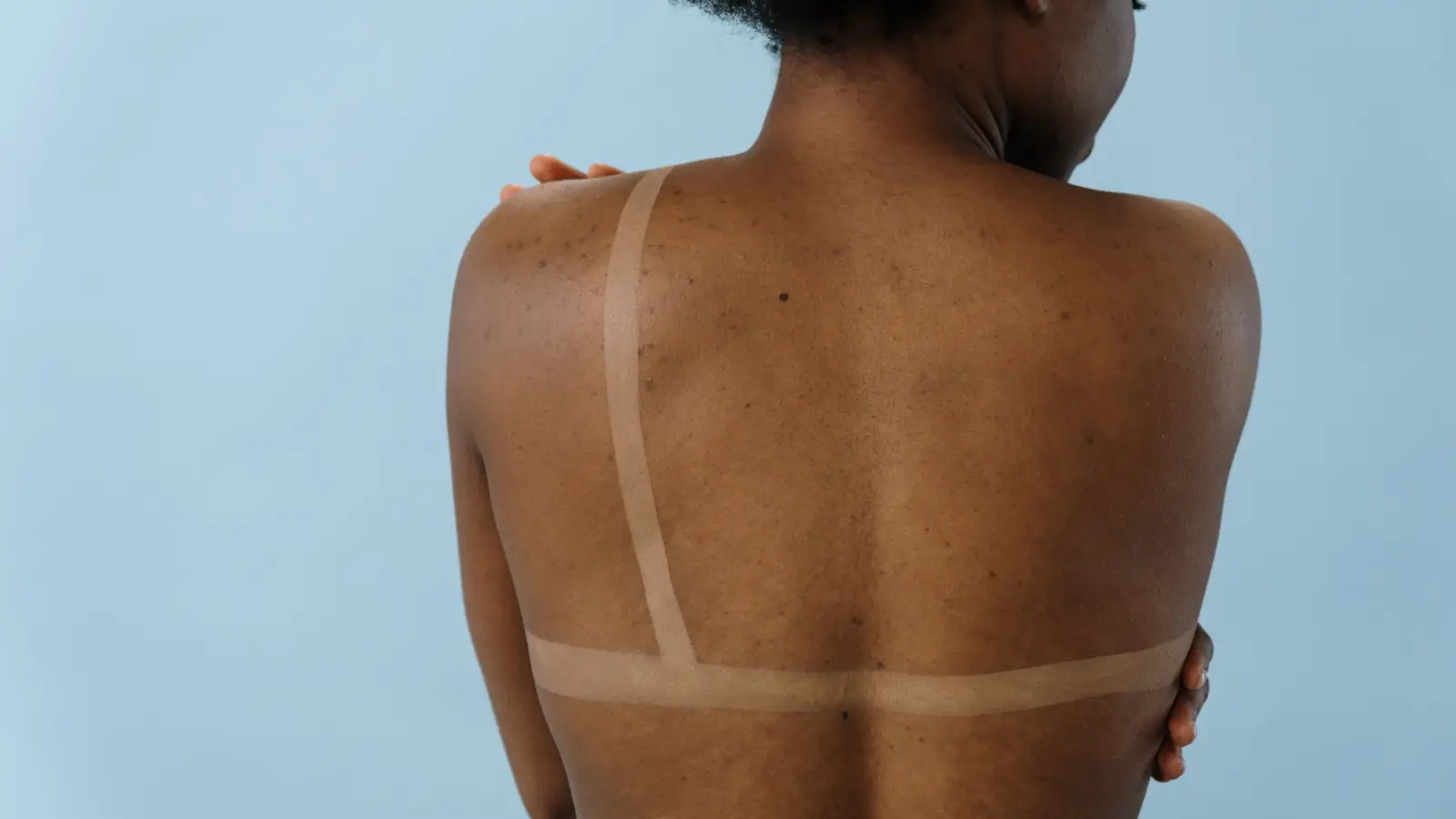 Why Sunscreen Alone Won't Stop PIH from Coming Back
